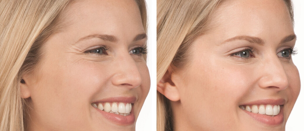Botox before and after in Boca Raton Medspa